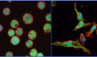 Linfocitos cancerígenos reprogramados en macrófagos. 